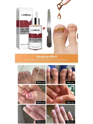 От грибка ногтей на ногах и руках LANBENA 27061443 купить в  интернет-магазине Wildberries
