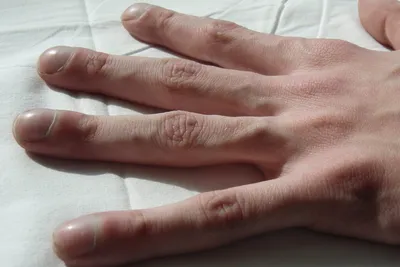Ногти Гиппократа или симптом барабанных палочек – причины, лечение и  профилактика