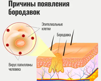Лазерное удаление бородавок - цена на удаление бородавок лазером в Москве -  клиника “Косметомед”
