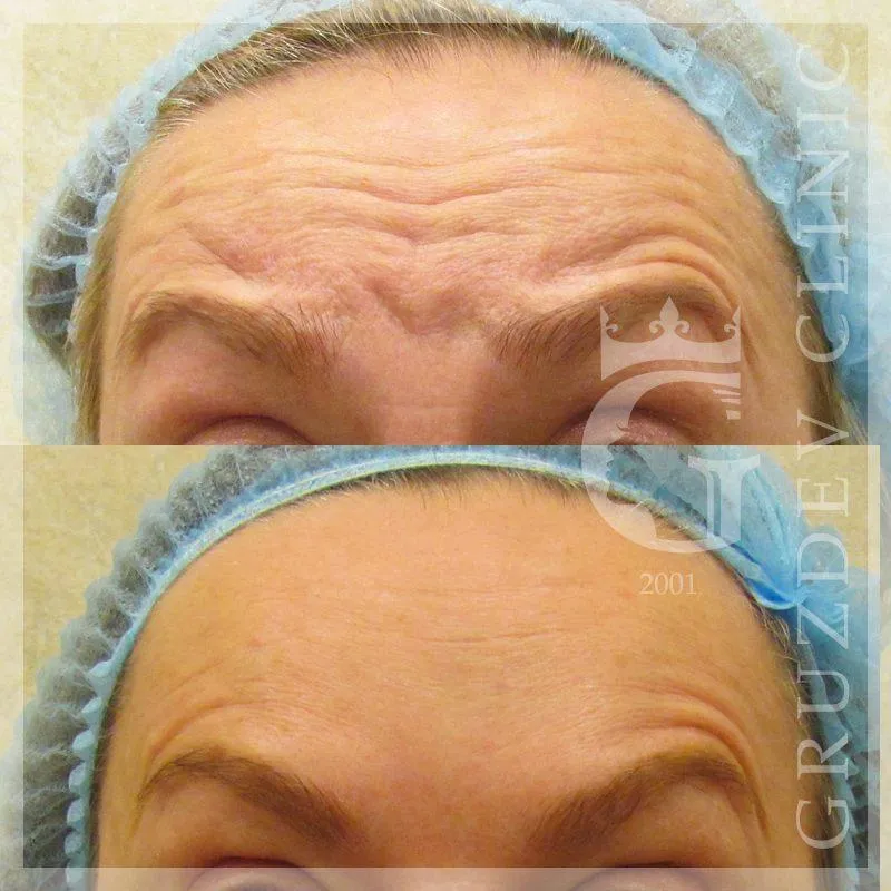 Ботулинотерапия от морщин skinlift ru. Ботулинотерапия в косметологии. Ботулинотерапия в косметологии лоб до и после.