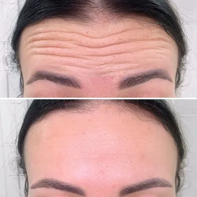 Курс: Ботокс. Нижняя треть. BOTOX. Lower third of the face