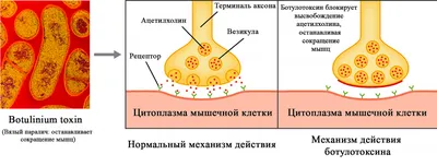 Ботокс и бруксизм: как это связано?