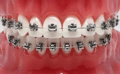 Самолигирующие (безлигатурные) брекеты в стоматологии Vimontale