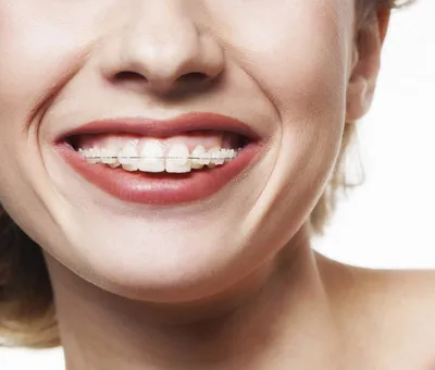 Белые брекеты: какие бывают и кому подойдут (+ видео) | Стоматология  Smile-at-Once | Дзен