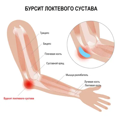 Бурсит сустава - лечение и симптомы, причины заболевания, какой врач лечит