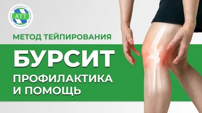 ✓ Бурсит коленного сустава | Тейпирование колена | Бурсит лечение - YouTube