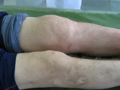 Фото Bursitis (бурсит)