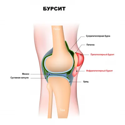 Бурсит сустава - лечение и симптомы, причины заболевания, какой врач лечит