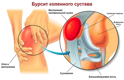 Бурсит сустава: лечение, симптомы, причины и показания к операции