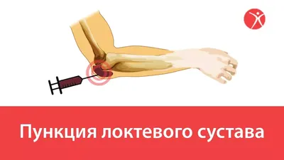 Бурсит локтевого сустава: причины, симптомы, лечение в Москве