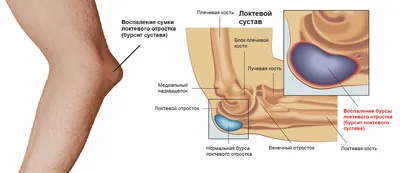Операция при бурсите сустава в Минске - клиника Золотое Сечение Мед
