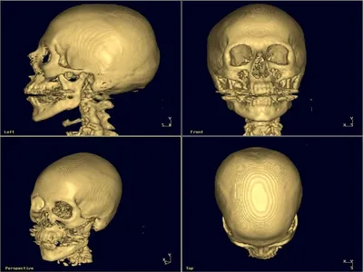 Компьютерная томография (КТ) лицевого черепа: клиники и цены в Москве