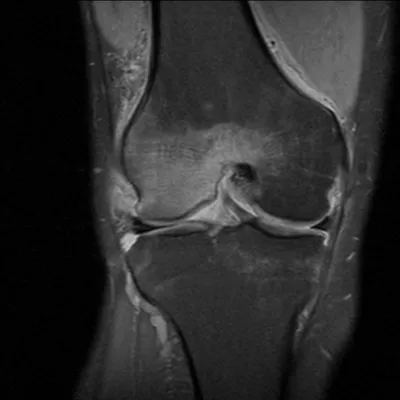 Внутрикостная липома (Intraosseous lipoma)