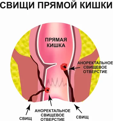 Что такое свищ фотографии