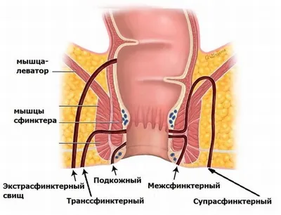 Свищ прямой кишки (параректальный свищ): причины, симптомы, виды,  осложнения, лечение, профилактика