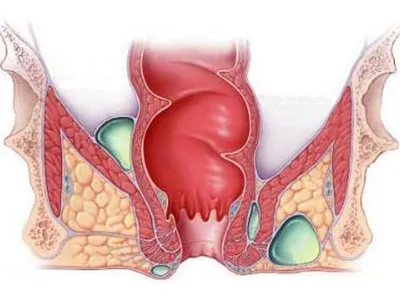 Парапроктит: коварный свищ и ложный стыд - KP.RU