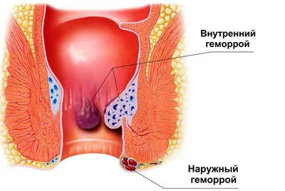 Свищ прямой кишки (параректальный свищ) - цены на лечение, симптомы и  диагностика ректальных свищей - Гармония