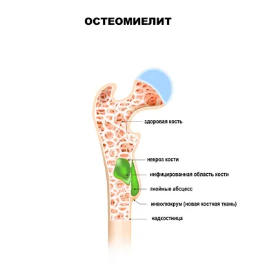 Остеомиелит - причины появления, симптомы заболевания, диагностика и  способы лечения