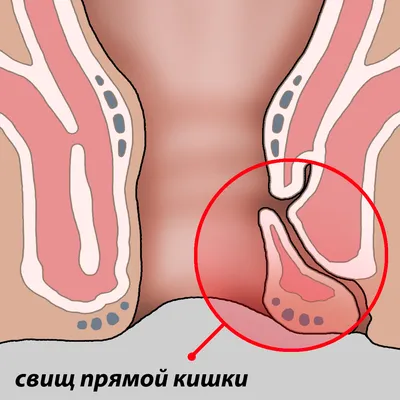 Свищ прямой кишки (параректальный свищ) - цены на лечение, симптомы и  диагностика ректальных свищей - Гармония