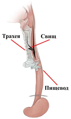 4.9. Трахео-пищеводные и пищеводно-бронхиальные свищи