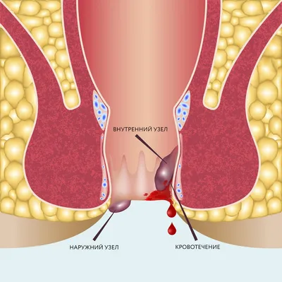 Свищ прямой кишки (параректальный свищ) - цены на лечение, симптомы и  диагностика ректальных свищей - Гармония