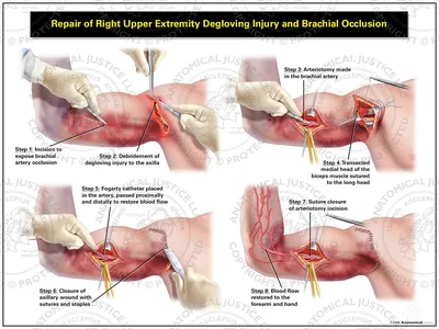 Right Upper Extremity Degloving Injury and Brachial Occlusion Repair