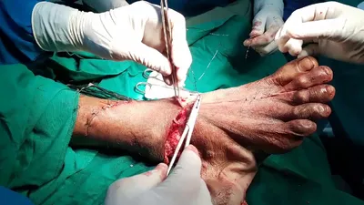 Foot and ankle degloving injury, primary suturing \u0026 secondary skin  grafting; Adamya Hosp videos - YouTube