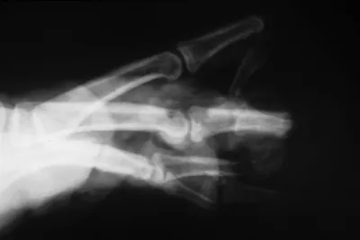 Trauma: Multiple finger degloving treated with medial cross arm flap and  temporary syndactyly