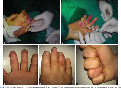 Replantation of a circumferentially degloved ring finger by venous  arterializations | Semantic Scholar