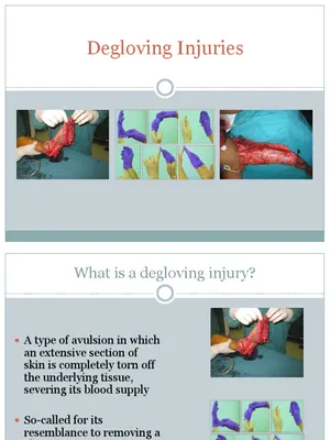 Degloving Injuries | PDF | Wound | Clinical Medicine