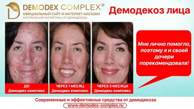Демодекоз лечение. Препараты Демодекс Комплекс. Отзыв. Схема лечения  демодекоза на лице у человека. - YouTube
