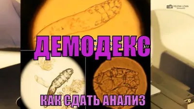 ПОДКОЖНЫЙ КЛЕЩ У ЧЕЛОВЕКА. Демодекс под микроскопом в лаборатории. СИМПТОМЫ  КАК ИЗБАВИТЬСЯ? - YouTube