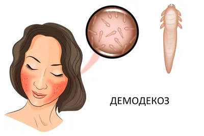 Демодекоз на лице, веках, голове, ресницах - лечение, симптомы, признаки
