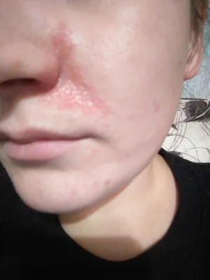 Аллергический дерматит на лице - Вопрос дерматологу - 03 Онлайн