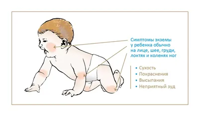Атопический дерматит у ребенка: симптомы и лечение - Статьи о детском  питании от педиатров и экспертов МАМАКО