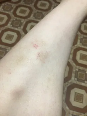 На ноге тоже проявление дерматита? Девушка, 21 год. На голени уже примерно  | MedAboutMe