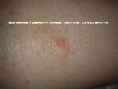 Экзематозный дерматит на руках и ногах: лечение заболевания