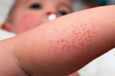 Атопический дерматит: что нужно знать вам и вашим детям