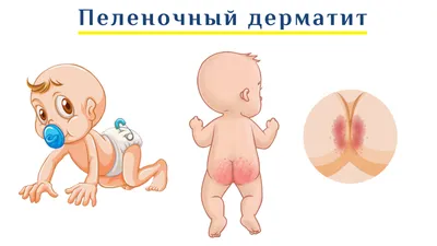 Пеленочный дерматит дифференциальная диагностика, лечение, симптомы, фото -  Университет здорового ребёнка Няньковских