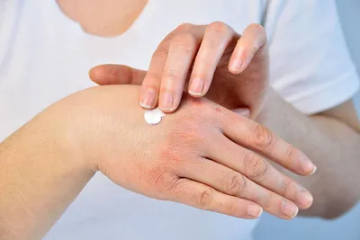 Сухая кожа рук и дерматит – что делать nail-мастеру и как предотвратить  заболевание?
