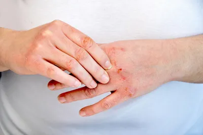 Болит, зудит или чешется: почему возникает дерматит и всегда ли виновна  аллергия? | О здоровье: с медицинского на русский | Дзен
