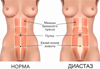 Диастаз прямых мышц живота: причины и лечение