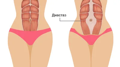 Диастаз прямых мышц живота – как вылечить?