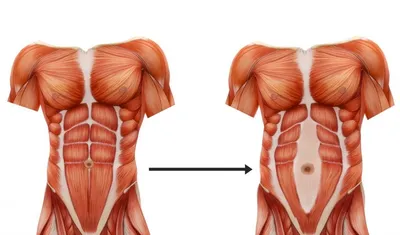 Как убрать диастаз — бесплатная операция по ОМС