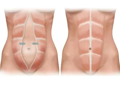 Диастаз прямых мышц живота: причины, симптомы и лечение в статье проктолога  Агапов М. А.