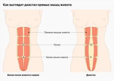 Есть ли у тебя диастаз прямых мышц живота?Простой тест в домашних условиях.  | Здоровая жизнь | Дзен