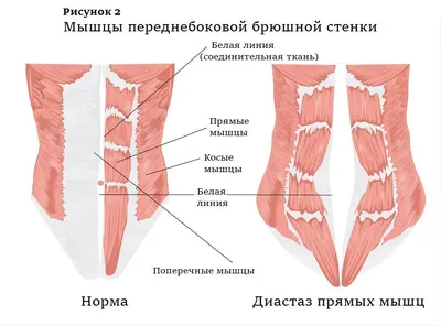 Диастаз мышц: что это такое и как с этим бороться