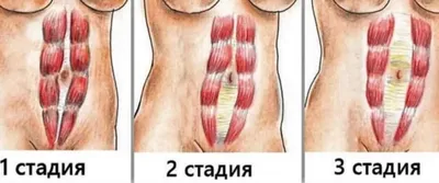 Диастаз прямых мышц живота | Study Guides, Projects, Research General  Surgery | Docsity