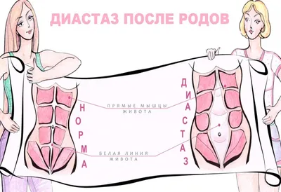 Диастаз прямых мышц живота | Александр Маркушин пластический хирург