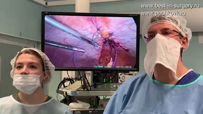 Диастаз прямых мышц живота - лапароскопическая операция, лапароскопия  [Видео]